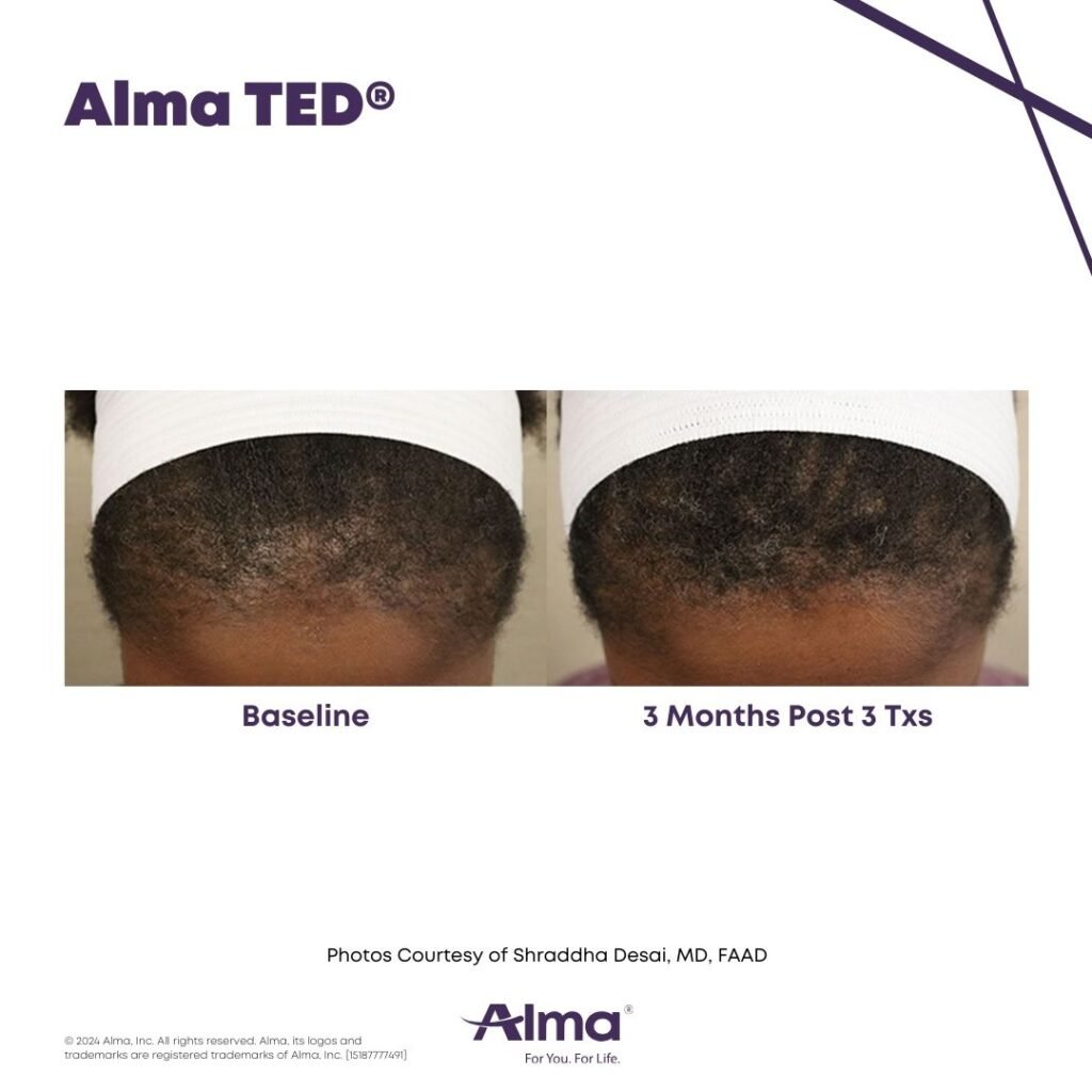 TED Hair Restoration Alma-TED-BA_S.Desai-Q4-24_15187777491_Canva