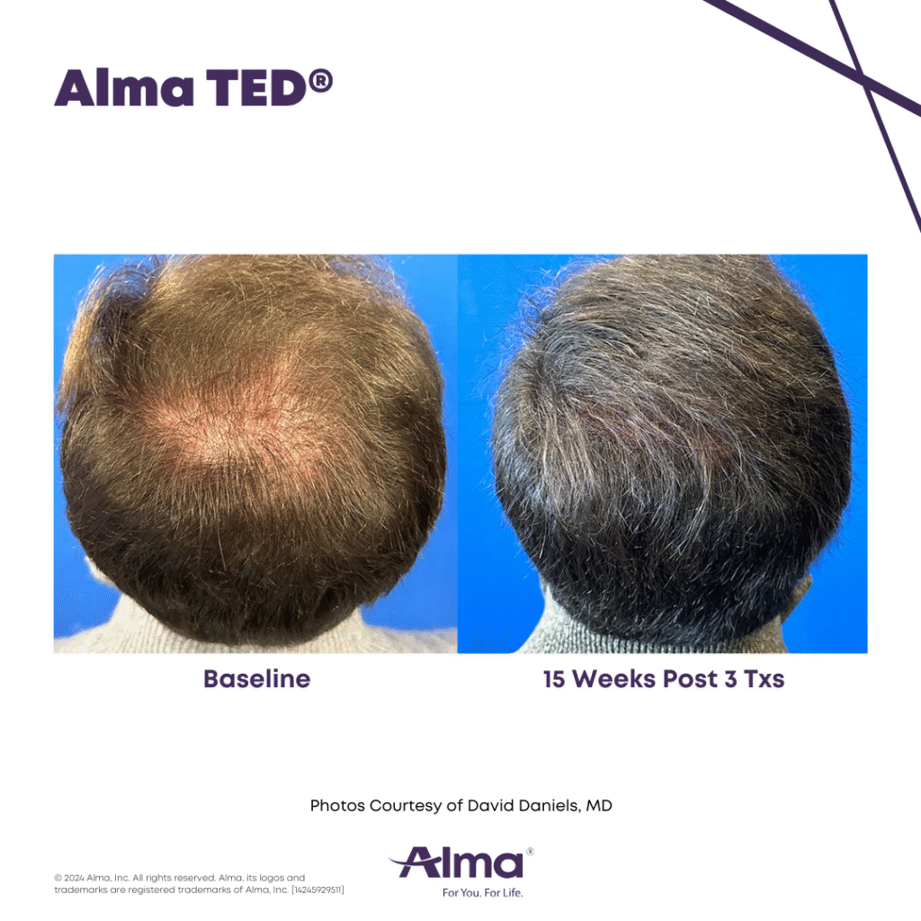 TED Hair Restoration Alma_TED_BA_D.Daniels_Q3-24_14245929511_Canva