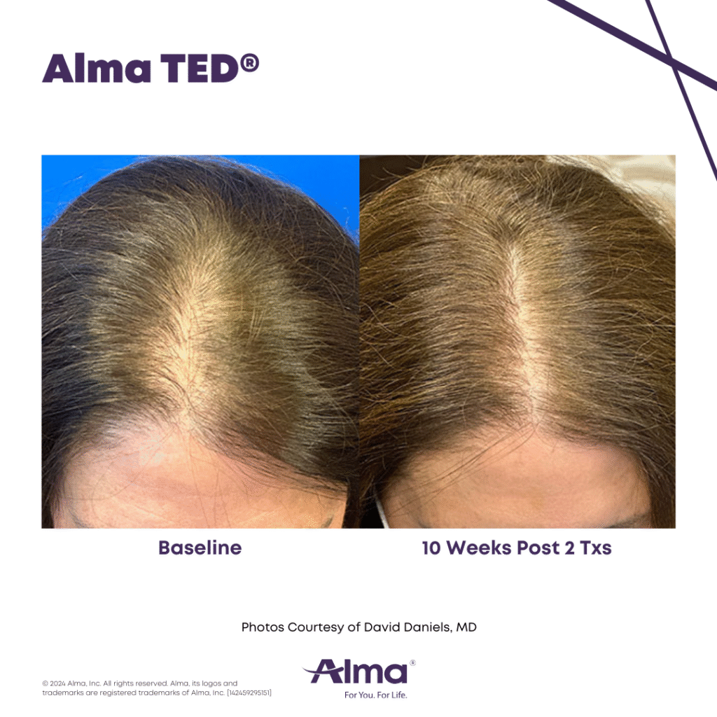 TED Hair Restoration Alma_TED_BA_D.Daniels_Q3-24_14245929515_Canva