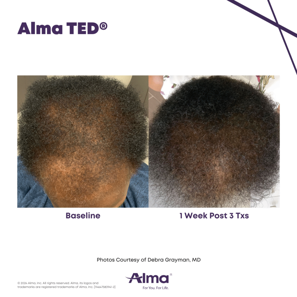 TED Hair Restoration Alma_TED_BA_D.Grayman_Q3-24_14647583941_Angle-2_Canva