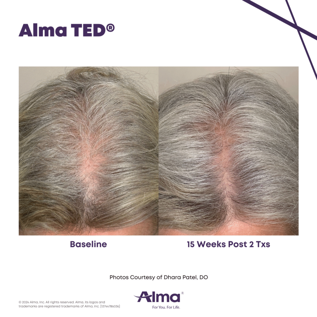 TED Hair Restoration Alma_TED_BA_D.Patel_Q3-24_13744786036_Canva