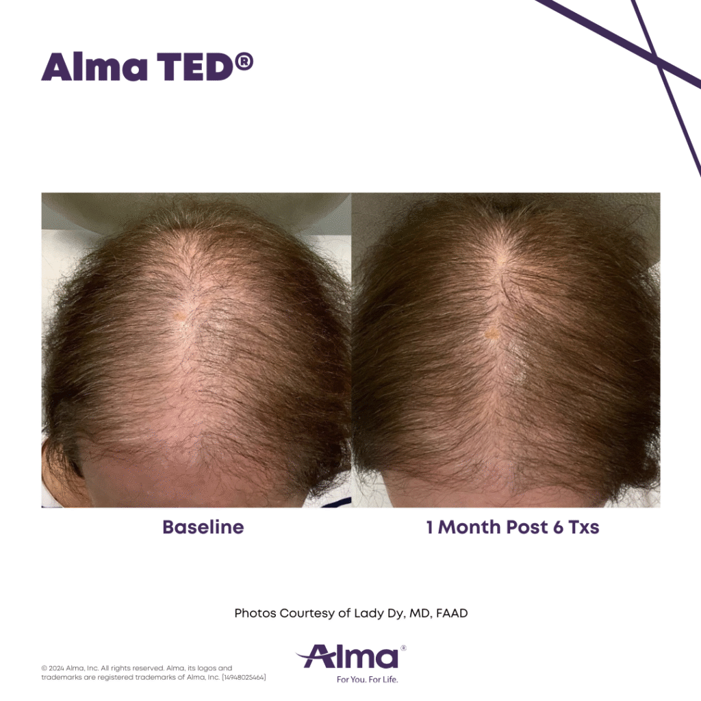 TED Hair Restoration Alma_TED_BA_L.Dy_Q3-24_14948025464_canva