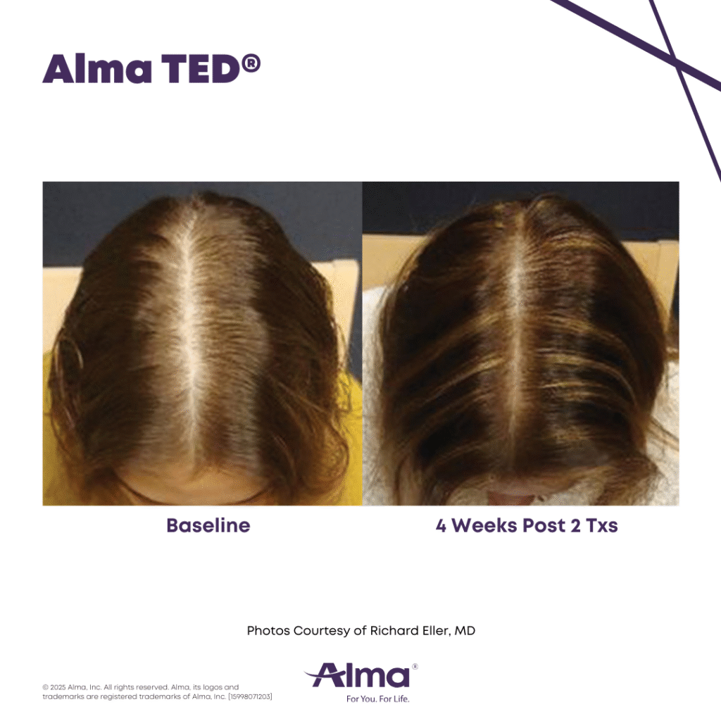 TED Hair Restoration Alma_TED_BA_R.Eller_Q1-25_15998071203_Canva