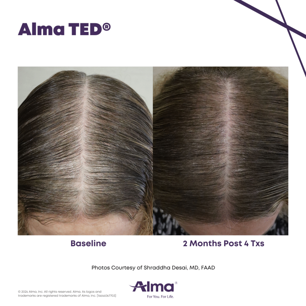 TED Hair Restoration Alma_TED_BA_S.Desai_Q4-24_14644067703_Canva