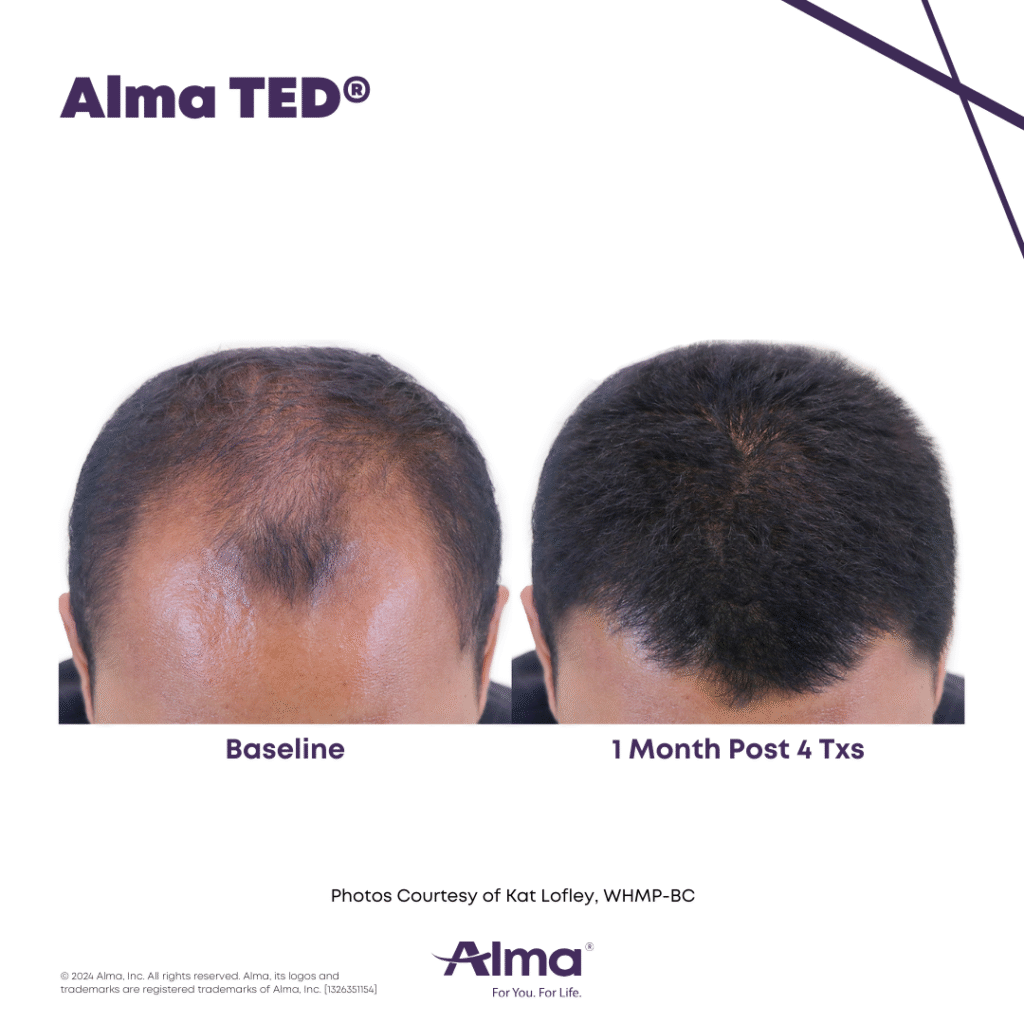 TED Hair Restoration Alma_Ted_BA_K.Lofley_Q1-24_1326351154_Canva