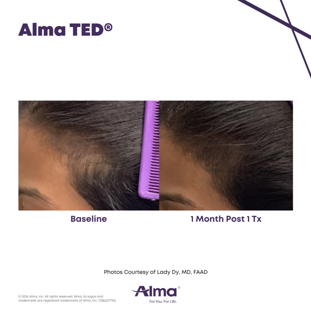 TED Hair Restoration Alma_Ted_BA_L.Dy_Q1-22_1384237796_canva